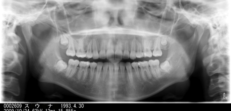 「ハリウッドスマイル12症例めの矯正歯科治療前のレントゲン」